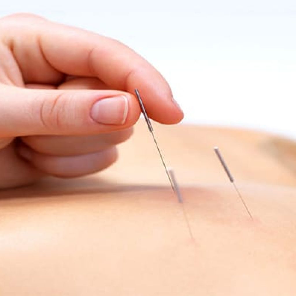Using Leading Chiropractic & Acupuncture Treatment