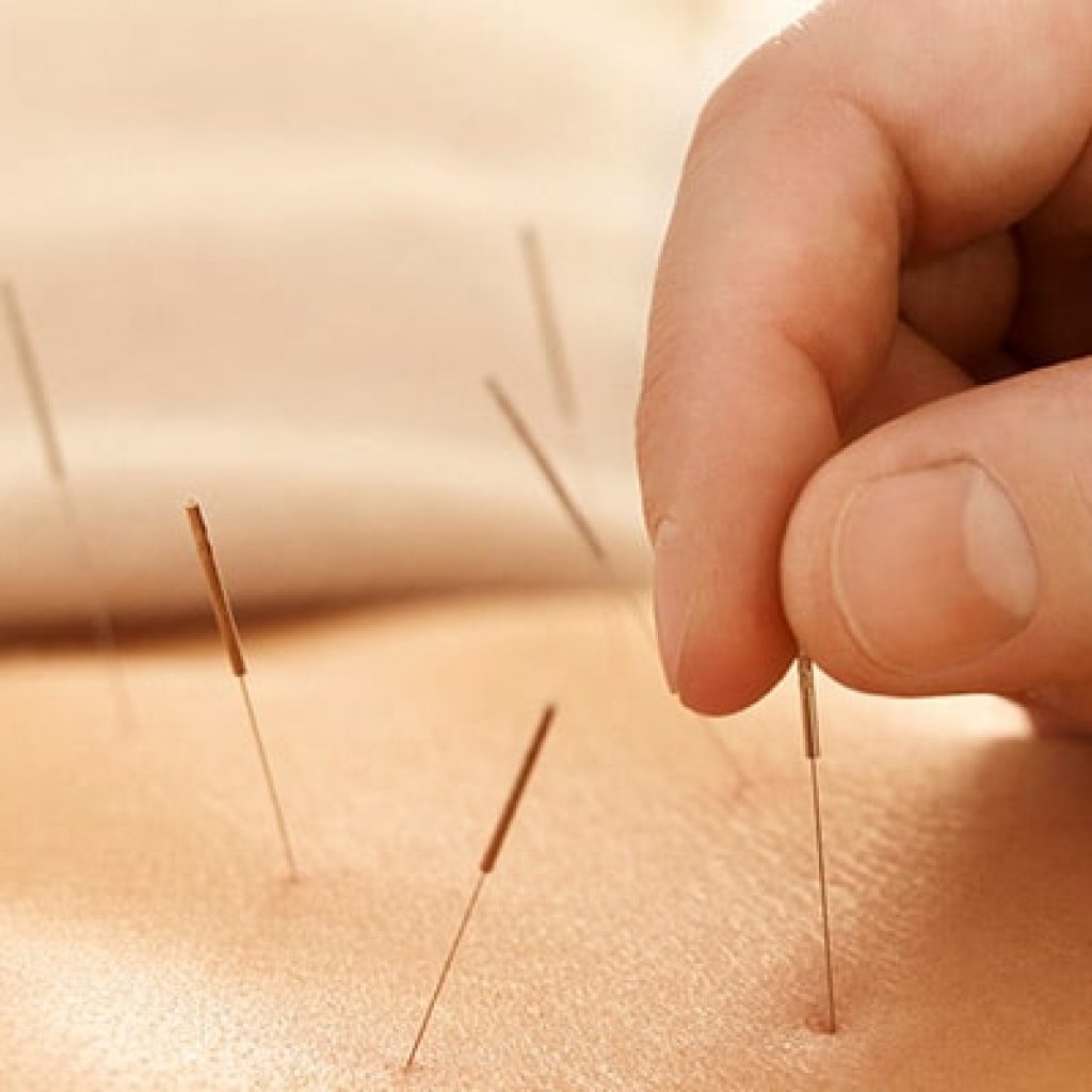 Birmingham Health acupuncture
